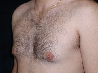 Male Breast Reduction