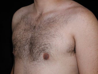 Male Breast Reduction