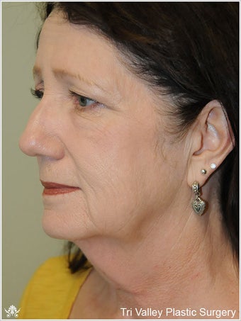 Facelift