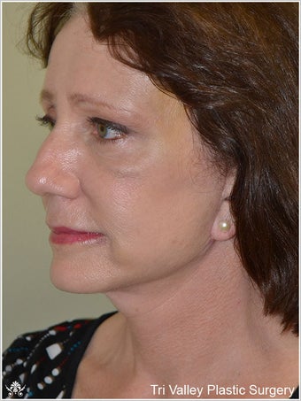 Facelift
