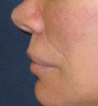 Lip lift