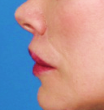 Lip lift