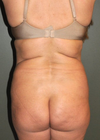 Body Liposuction