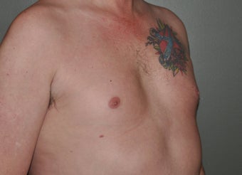 Pec Implants