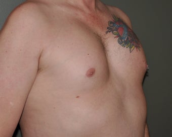 Pec Implants