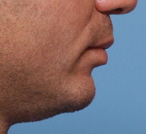 Chin Augmentation