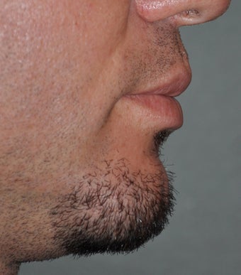 Chin Augmentation
