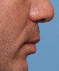 Lip Lift