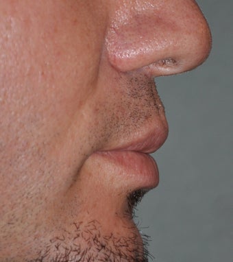 Lip Lift