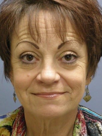 Lite Lift, Brow Lift