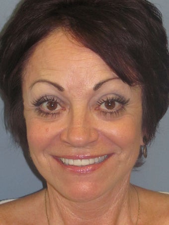 Lite Lift, Brow Lift