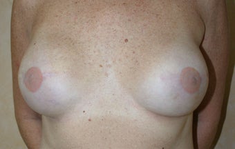 Breast Reconstruction