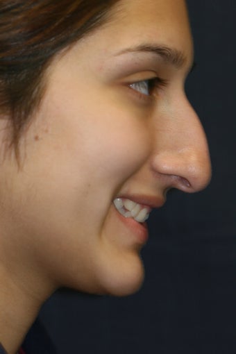 Rhinoplasty and Septoplasty