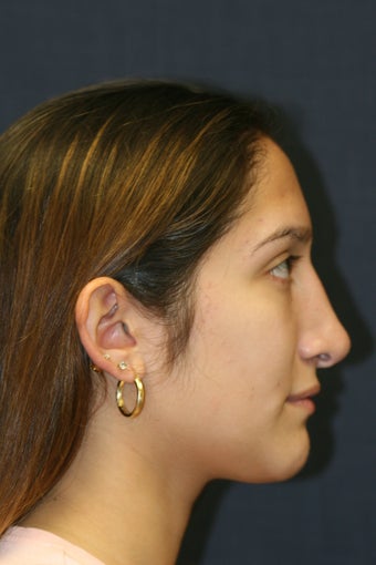 Rhinoplasty and Septoplasty
