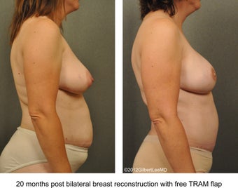 Breast Reconstruction
