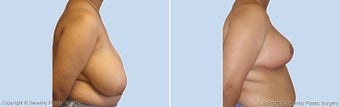 Breast Reduction, Breast Lift