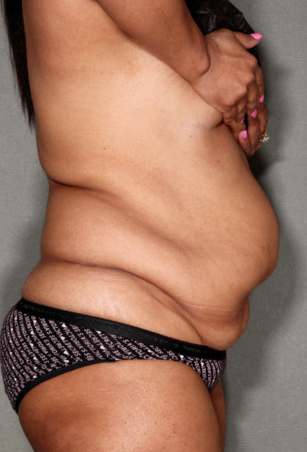 SmartLipo™ 