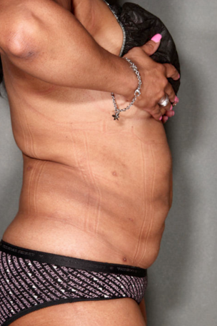 SmartLipo™ 