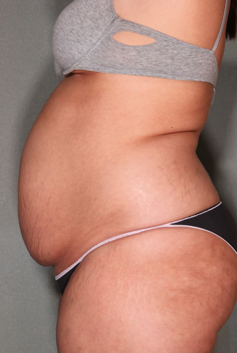 SmartLipo™ 