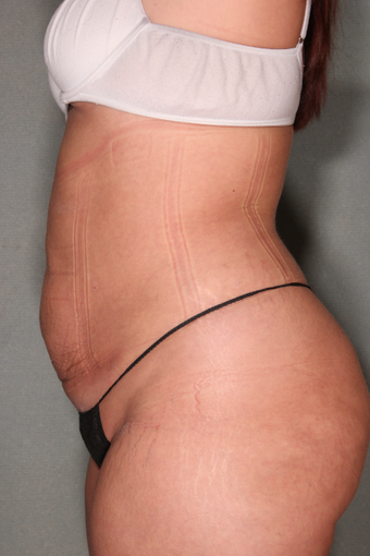 SmartLipo™ 
