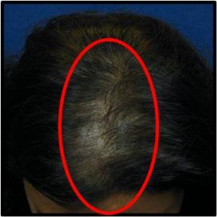 Female Hair Restoration