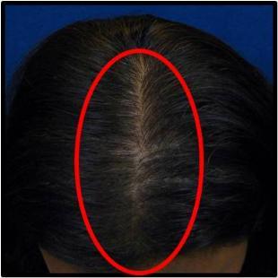 Female Hair Restoration