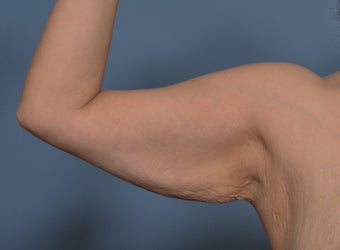 Arm Lift