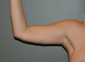 Arm Lift