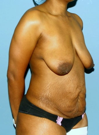 Breast lift and tummy tuck
