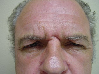 Botox