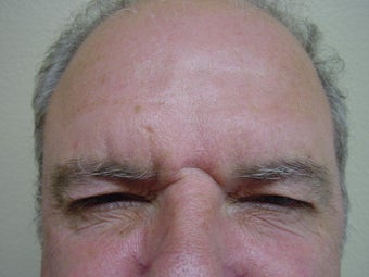 Botox