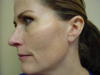 Microlaser Peels