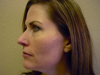 Microlaser Peels