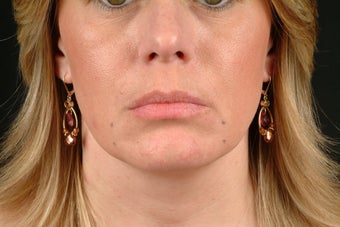 Botox