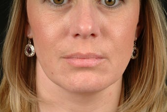 Botox