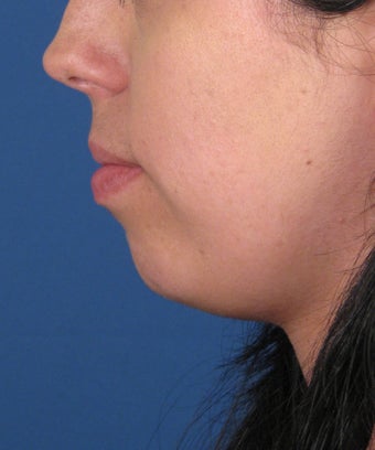 Chin Implant