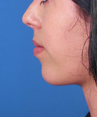 Chin Implant