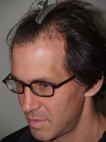 Hair Grafts
