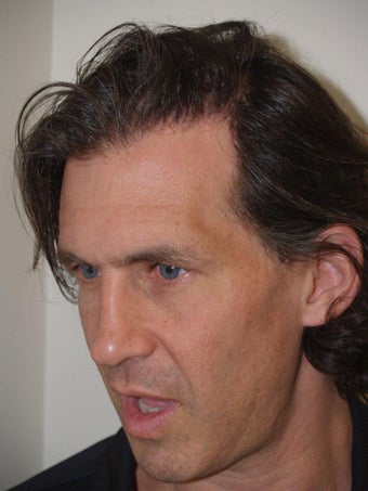 Hair Grafts