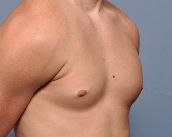 Pectoral Implants