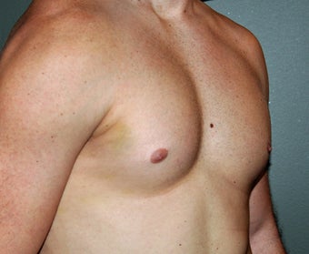 Pectoral Implants