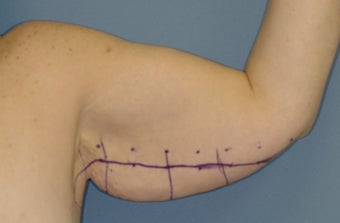 Arm Lift