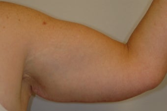 Arm Lift