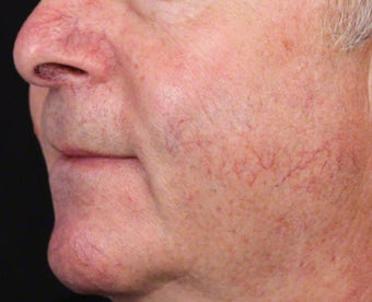 Vbeam for Facial Veins