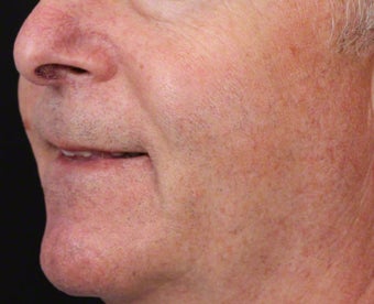 Vbeam for Facial Veins
