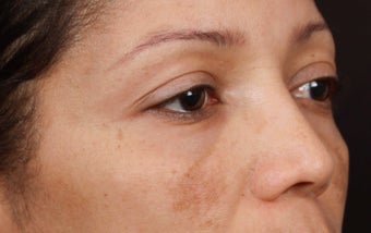 Cosmelan MD for Facial Pigmentation