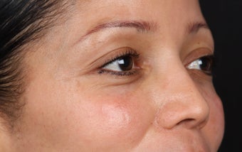 Cosmelan MD for Facial Pigmentation