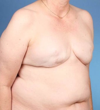 Breast Reconstruction