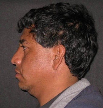 Rhinoplasty, Nasal Fracture Repair