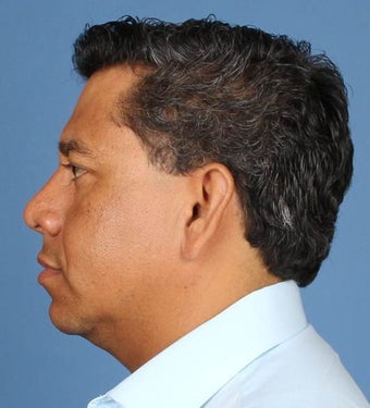 Rhinoplasty, Nasal Fracture Repair